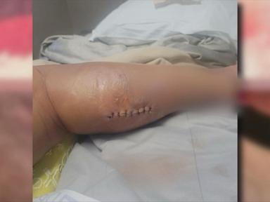 Source-feed image associated with WATCH: Mom says she was given days to live after spider-bite nightmare