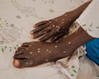 Source-feed image associated with Mpox is back – and in new countries. How can this outbreak be contained?