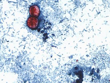 Source-feed image associated with 15 states now linked to iceberg lettuce cyclospora outbreak, CDC says