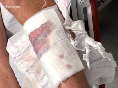 Source-feed image associated with WATCH: Connecticut man speaks out after shark attack in the Bahamas