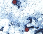 Source-feed image associated with US outbreak of parasite causing ‘watery diarrhea’ rises to more than 2,800 cases