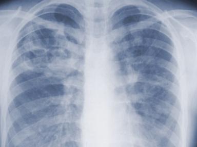 Source-feed image associated with Study suggests the threat of mold-associated illnesses may be underappreciated
