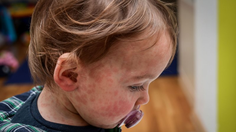 Source-feed image associated with Measles has no treatments. Changing that may not be easy