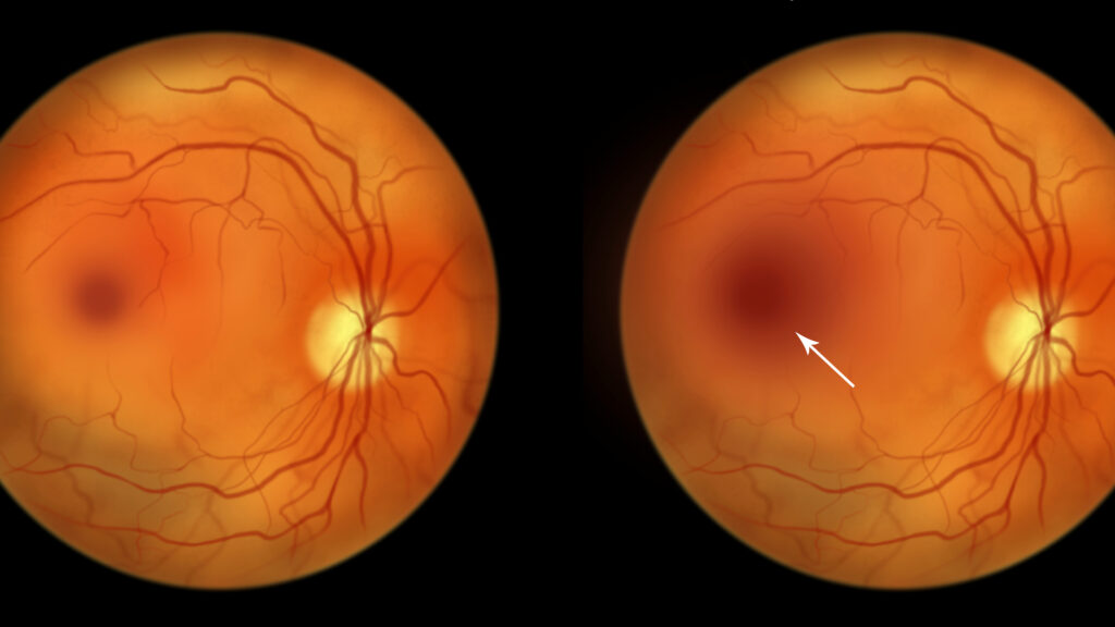 Source-feed image associated with STAT+: Ophthalmology venture grabs investors’ attention, raises $330 million