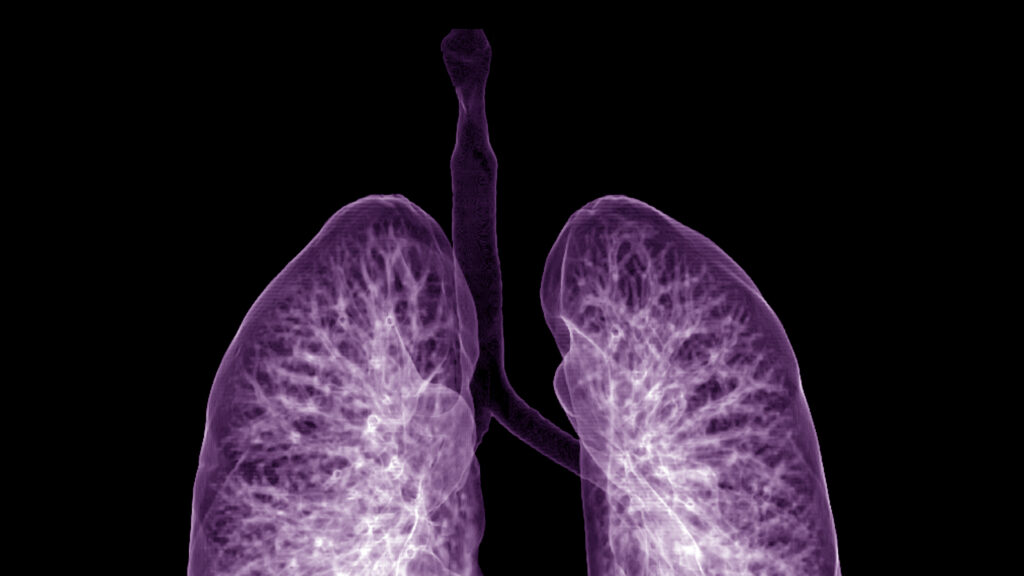 Source-feed image associated with STAT+: Sionna’s experimental cystic fibrosis pill falls flat in mid-stage trial