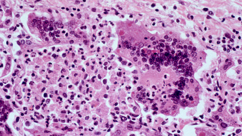 Image from linked report: One of the most contagious diseases on the planet is having its worst U.S. outbreak since 1991