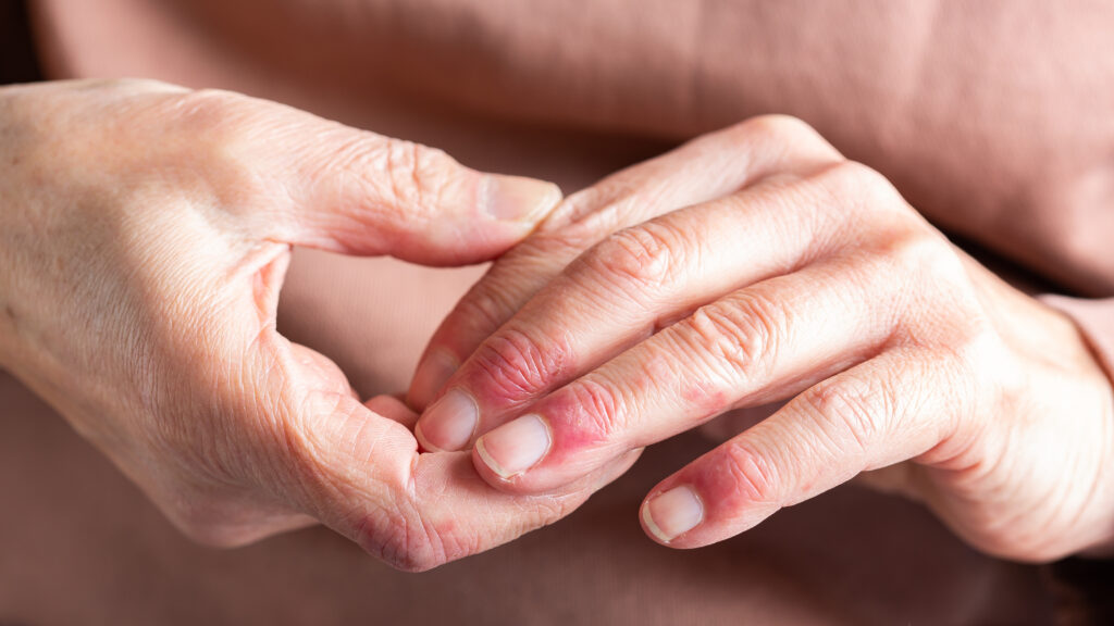 Source-feed image associated with STAT+: Talawar bets bispecific approach can shake up eczema market