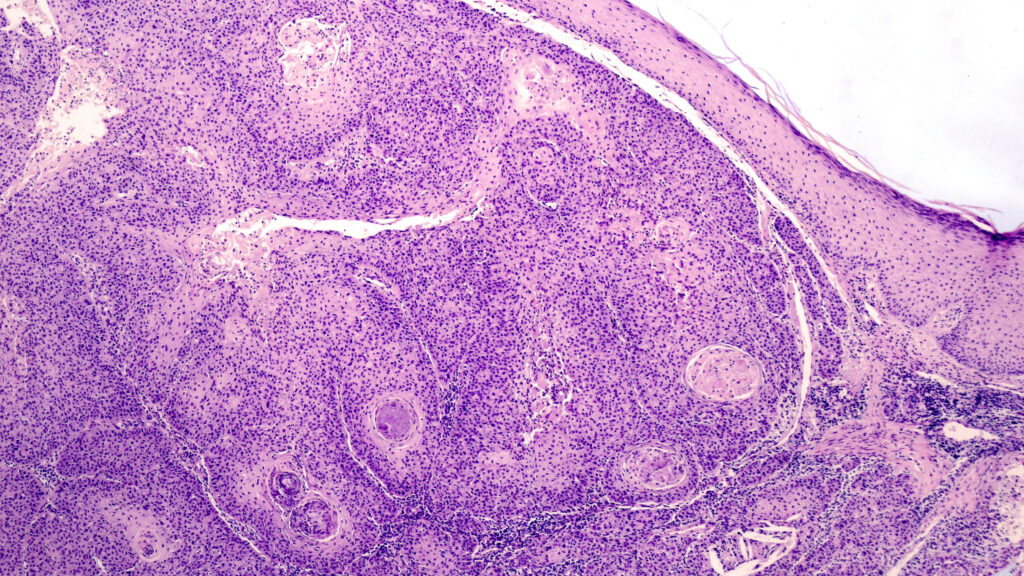 Source-feed image associated with STAT+: FDA expert committee votes in favor of Replimune’s melanoma treatment