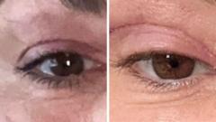 Image from linked report: 'My eyelids became infected - I was scared to sleep'
