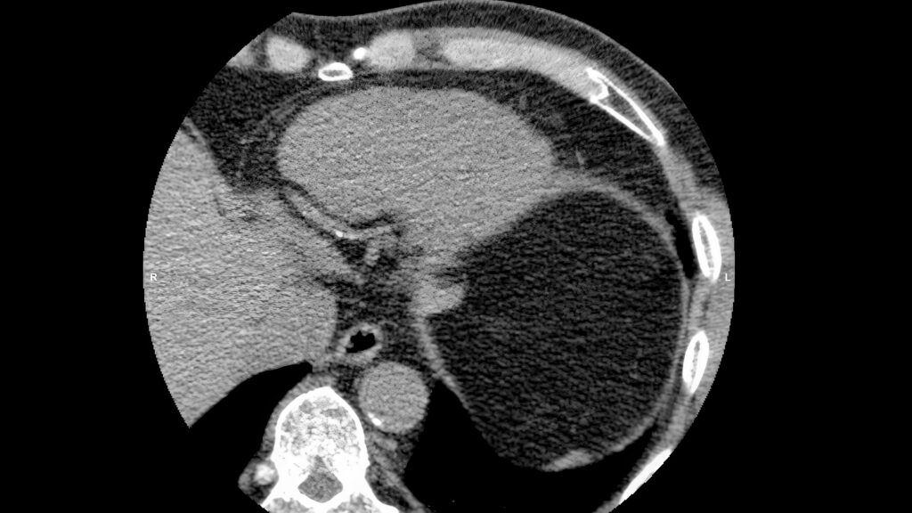Source-feed image associated with On the fence about a statin? In borderline cases, calcium scans could be a tiebreaker