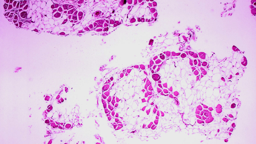 Source-feed image associated with STAT+: FDA expert panel recommends against approval of Capricor’s Duchenne drug