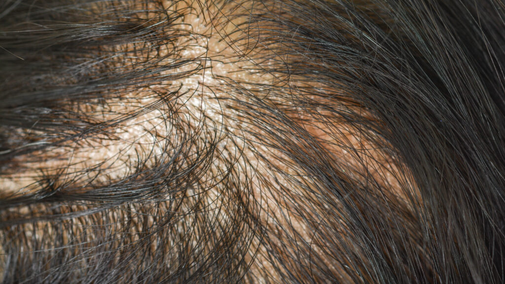 Source-feed image associated with STAT+: Eli Lilly dives into hair loss treatments with investment in AI startup Absci