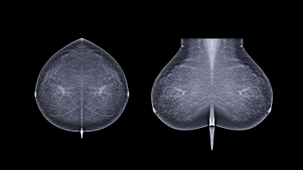 Image from linked report: STAT+: Why this startup is taking its AI to predict breast cancer risk directly to patients