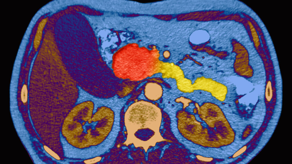 Source-feed image associated with STAT+: A breakthrough in pancreatic cancer has experts excited — and braced for what’s to come