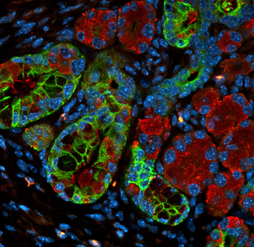 Image from linked report: STAT+: Verastem’s KRAS inhibitor shows promise in pancreatic cancer