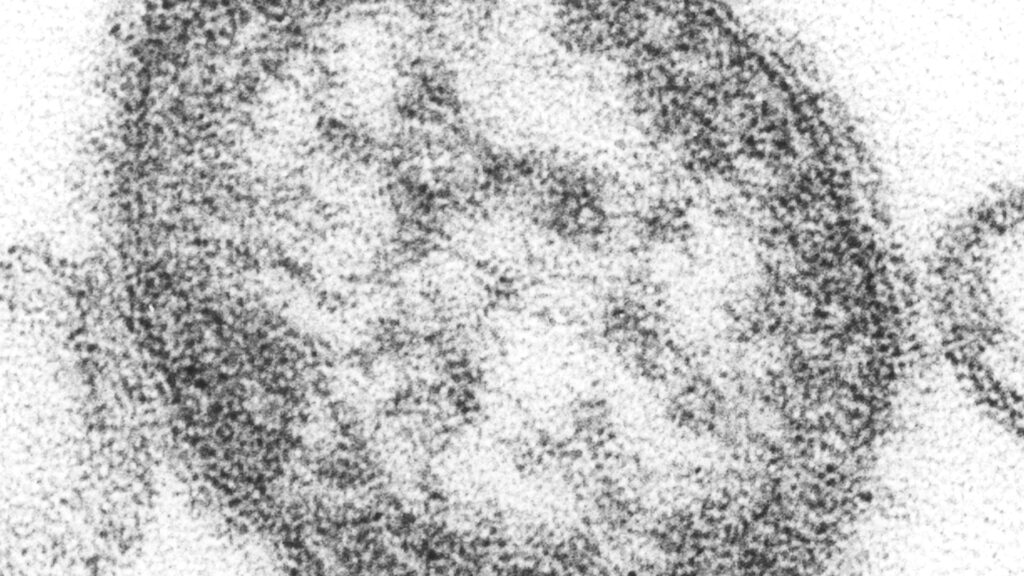 Source-feed image associated with Opinion: What my colleagues and I will look for as we assess U.S. measles elimination status
