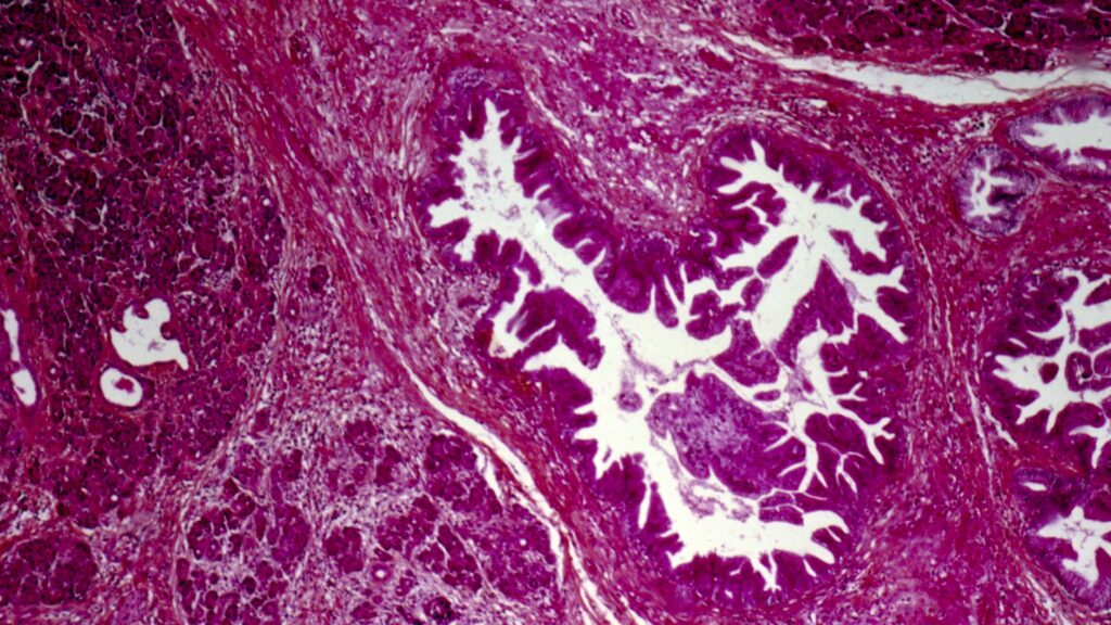 Source-feed image associated with STAT+: A turning point for pancreatic cancer patients