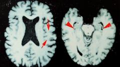 Source-feed image associated with Brain disease in dead NFL players 'higher than previously shown'