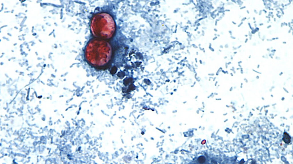 Source-feed image associated with U.S. health officials are investigating a new outbreak of a diarrhea-causing parasite