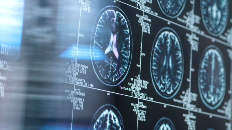 Image from linked report: MRIs show brain changes linked to Alzheimer’s years in advance