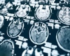 Source-feed image associated with Hundreds of ageing Americans may not get results of Alzheimer’s study due to Trump cuts