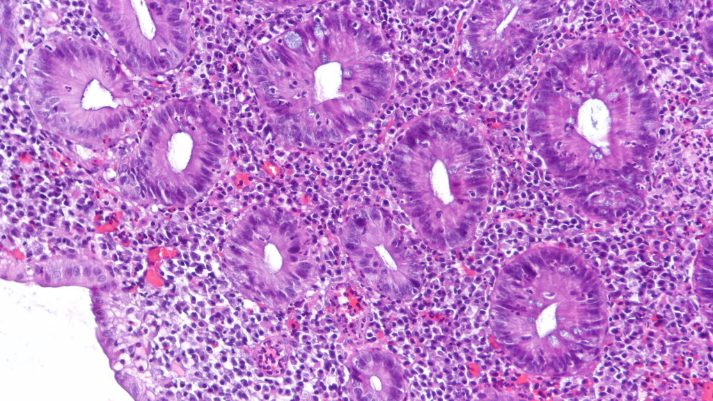 Source-feed image associated with STAT+: Abivax seeks to ease safety concerns with new data, boosting shares