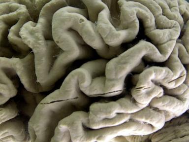 Source-feed image associated with Blood test can help identify people at high risk for Alzheimer's, study shows