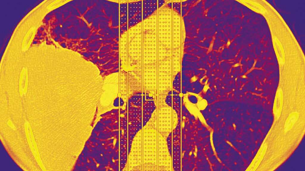 Source-feed image associated with STAT+: Why do ‘never-smokers’ get lung cancer? In some cases, rare genetic variant may be a factor