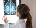 Source-feed image associated with AI can detect heart disease in women using mammograms, study suggests