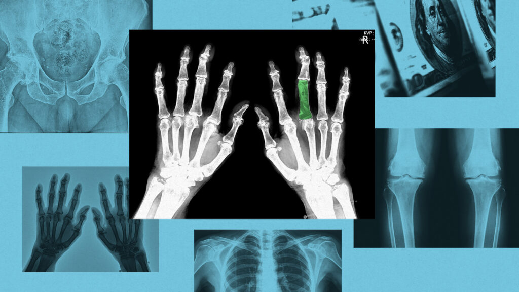Image from linked report: STAT+: Drugmakers, biotech VCs show ‘reinvigorated’ interest in osteoporosis treatments