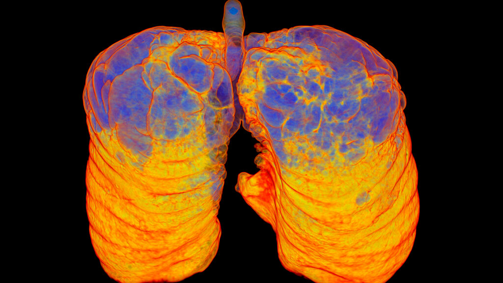 Source-feed image associated with STAT+: AstraZeneca’s experimental COPD treatment posts strong results in late-stage studies