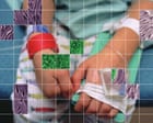 Source-feed image associated with Autistic children injected with unapproved stem cell treatments supported by RFK Jr