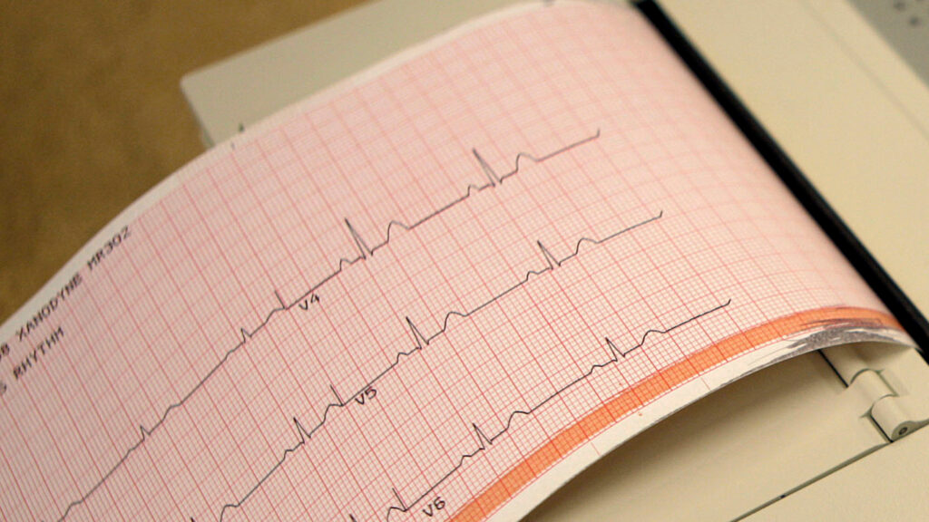 Source-feed image associated with Opinion: Florida is the first state to require EKGs for high school athletes. It’s a mistake