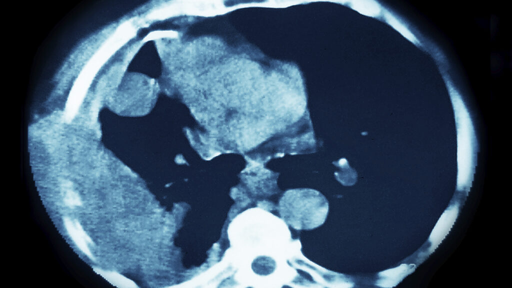 Source-feed image associated with STAT+: Akeso and Summit’s ivonescimab extends survival in squamous cell lung cancer