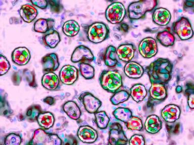 Source-feed image associated with Another measles-related death reported in Pennsylvania as outbreak grows